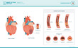 © elenabsl - Anatomy of a heart attack