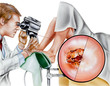 Cervical laser surgery to precisely remove abnormal tissues from the cervix (sparing normal tissue).