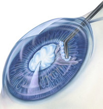 A Cataract Is An Eye Disease In Which The Normally Clear Lens Of The Eye Becomes Cloudy Or Opaque, Causing A Decrease In Vision. 