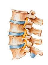 Spine - Nerve Irritation Caused By Bone Overgrowth In A Section Of The Spine. Bone Spurs Are Putting Pressure On Spinal Root Nerves On The Dorsal Side Of The Spine...