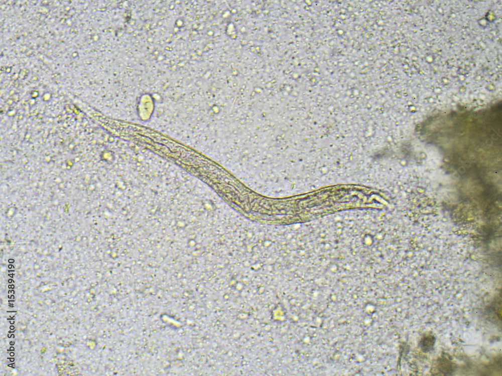 Strongyloides stercoralis (threadworm) in stool, analyze by microscope ...