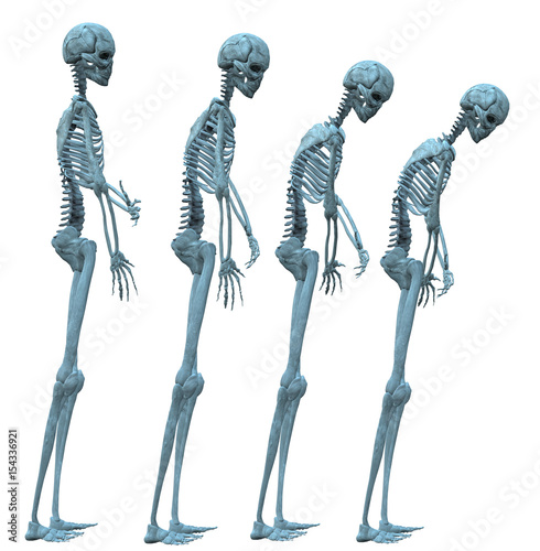 Fotomural Development of osteoporosis