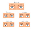 Crossed eyes vector illusration. Types of crossed eyes