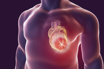 Heart attack, conceptual image for heart diseases. 3D illustration