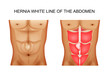 hernia white line of the abdomen 2