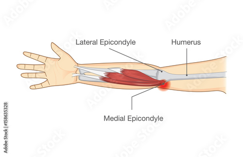 Fotografía Muscle injury and tear in tendon at elbow area from twisting and motions
