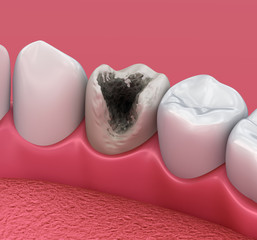 Teeth with caries, treatment. Medically accurate tooth 3D illustration