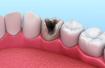 Wall Mural - Teeth with caries, treatment. Medically accurate tooth 3D illustration