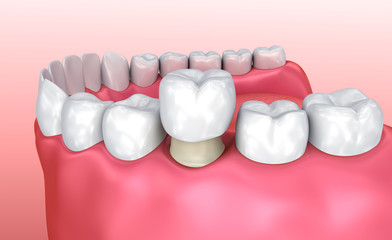 Wall Mural - Dental crown installation process, Medically accurate 3d illustration