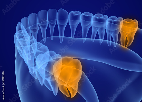 Fotografía Wisdom tooth xray view. Medically accurate tooth 3D illustration