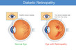 Anatomy of normal eye and Diabetic retinopathy in people who have diabetes. Illustration about health and eyesight.