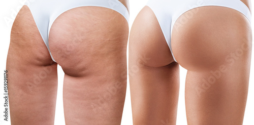 Fotografie, Obraz Female buttocks before and after treatment.