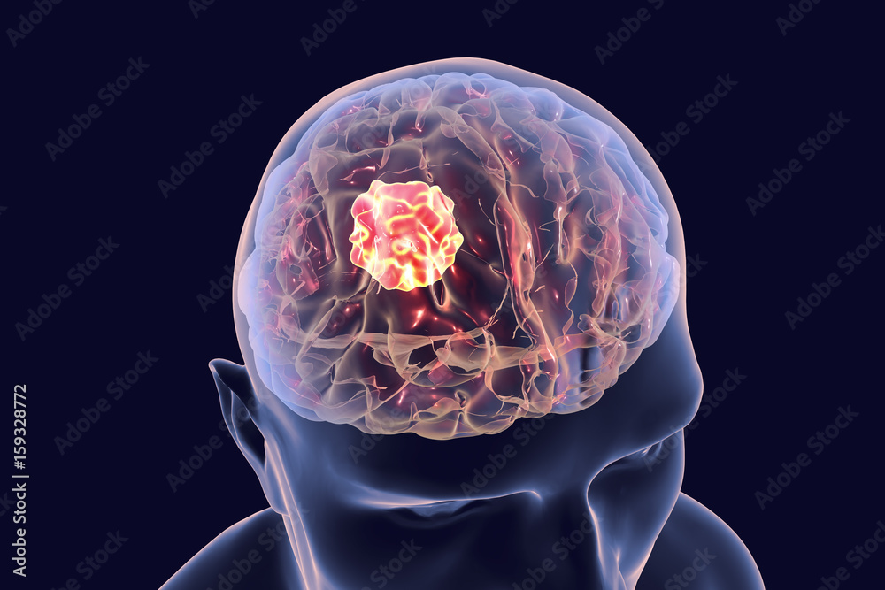 Brain cancer, 3D illustration showing presence of tumor inside brain ...