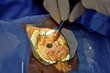 © RF BSIP - CATARACT, SURGERY
