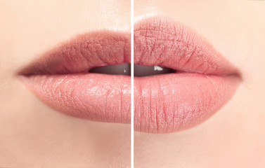 Sticker - Female lips before and after augmentation procedure. Beauty concept