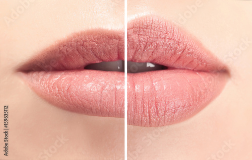 Photographie Female lips before and after augmentation procedure