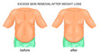 removal of excess skin after weight loss