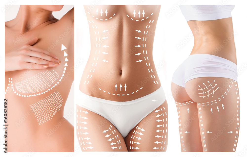 The cellulite removal plan. White markings on young woman body - obrazy, fototapety, plakaty 