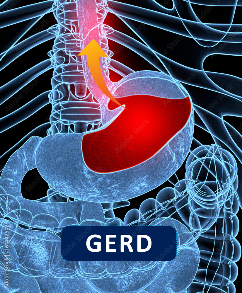 Gerd Overview Acid reflux, GERD. Gastroesophageal reflux disease. Diagram with title ...
