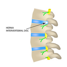 A Hernia Of The Intervertebral Disc. Vector Illustration On Isolated Background.