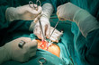 Appendectomy surgery procedure with small incision by surgery doctor. Step by step.Operative Procedure.