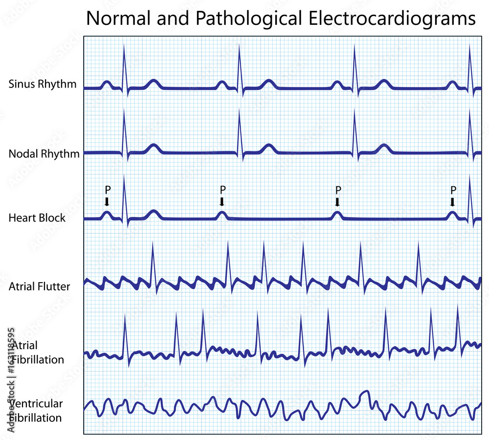 Normal and diseased ecg collection Stock Illustration | Adobe Stock