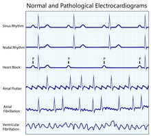 Normal And Diseased Ecg Collection