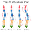 Types of scoliosis of spine.