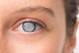 Fototapeta  - Eye of young girl with corneal opacity