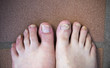 onychomycosis with fungal nail infection two feet