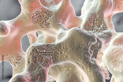 Fotografía Spongy bone tissue affected by osteoporosis, 3D illustration