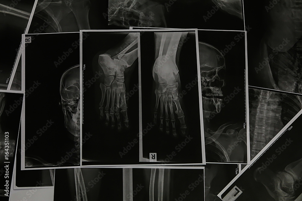 Xray right foot.X-ray foot collection show bone deformity in lateral ...