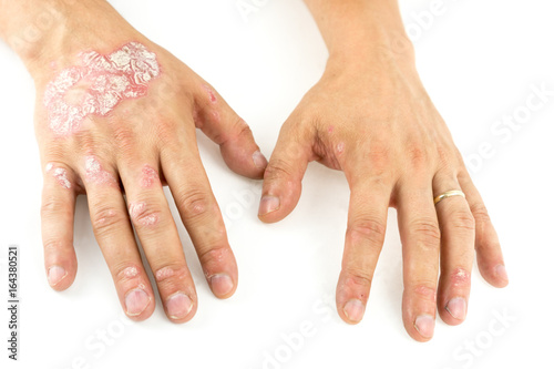 Pinturas sobre lienzo Psoriasis vulgaris on the mans hands with plaque, rash and patches, isolated on white background