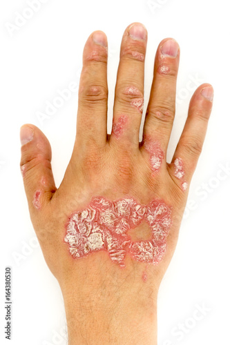 Fotografía Psoriasis vulgaris on the man hand and finger nails with plaque, rash and patches, isolated on white background