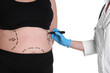 Doctor marking stout woman's belly for plastic surgery. Weight loss concept