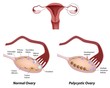 Normal ovary and Polycystic ovary syndrome