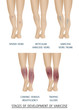 Types of varicose veins in women. Stages of development of varicose veins, vector illustration.