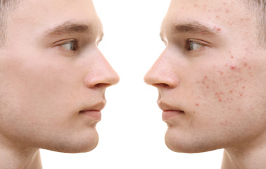 Handsome young man with problem skin on white background