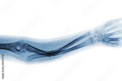 Cuadros en Lienzo Film x-ray forearm AP show fracture shaft of ulnar bone