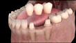 Dental anatomy - Lower teeth dental bridge with bone structure, teeth and gum section