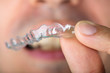 © Andrey Popov - Man Holding Transparent Teeth Aligners