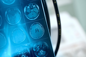 Wall Mural - MR image in frontal section of patient brain