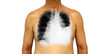 Lung cancer . Human chest and x-ray show pleural effusion left lung due to lung cancer