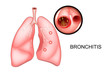 the lungs, affected with bronchitis