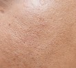 pores and oily on surface young asian man face skin do not take care for a long time