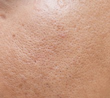 Pores And Oily On Surface Young Asian Man Face Skin Do Not Take Care For A Long Time