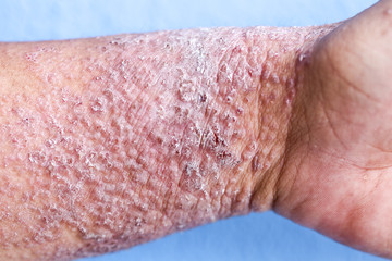 Atopic dermatitis (AD), also known as atopic eczema, is a type of inflammation of the skin (dermatitis).