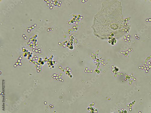 Pseudohyphae and Budding Yeast Cells in Patient Urine Stock Image - Image of dis