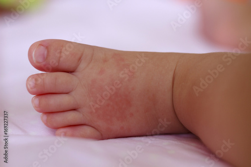 Pie De Bebe Con Granitos Por Calor Stock Photo Adobe Stock
