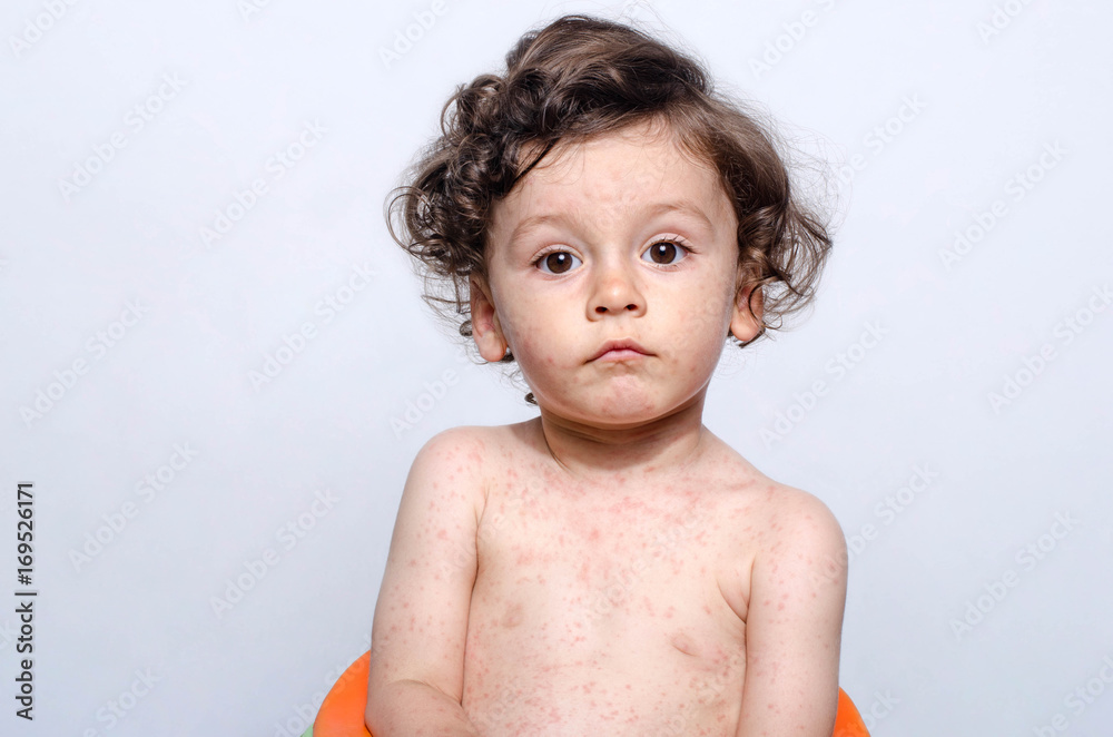 Portrait of a cute sick baby boy. Adorable upset child with spots on his face and body form illness, mosquito bites, roseola, rubella, measles. - obrazy, fototapety, plakaty 